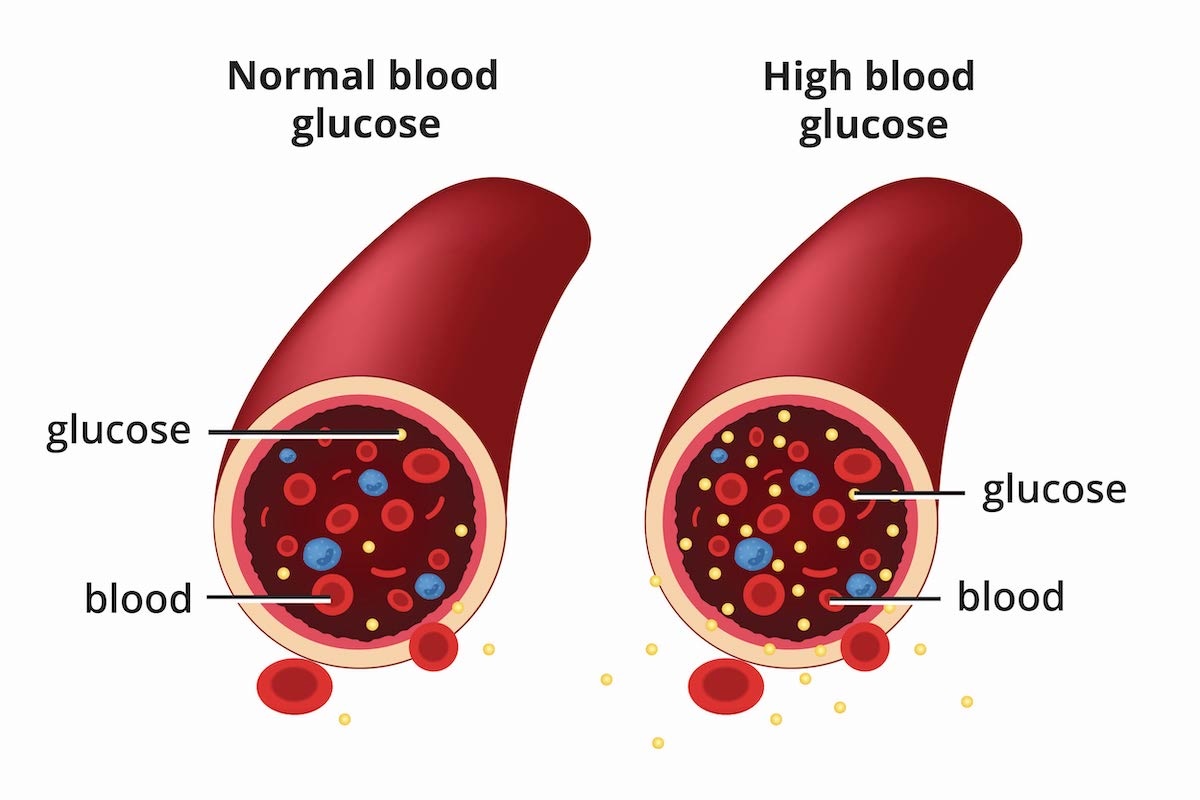 Normal Blood Glucose High Blood Glucose diagram Normal Blood Glucose High Blood Glucose diagram