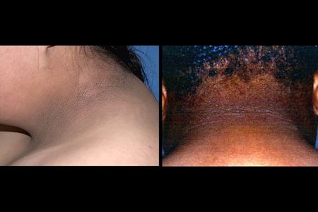 side-by-side-examples-of-acanthosis-nigricans